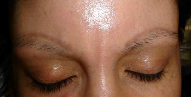 12-18-13_Before_brow_removal_%282%29.JPG