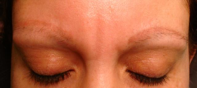 3-15-14_Brows_After_1_Treatment.JPG